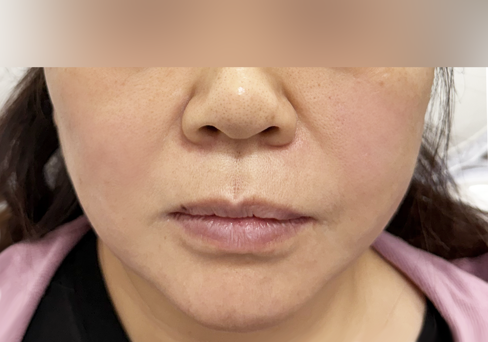 after result of pdo threadlift treatment for comparison