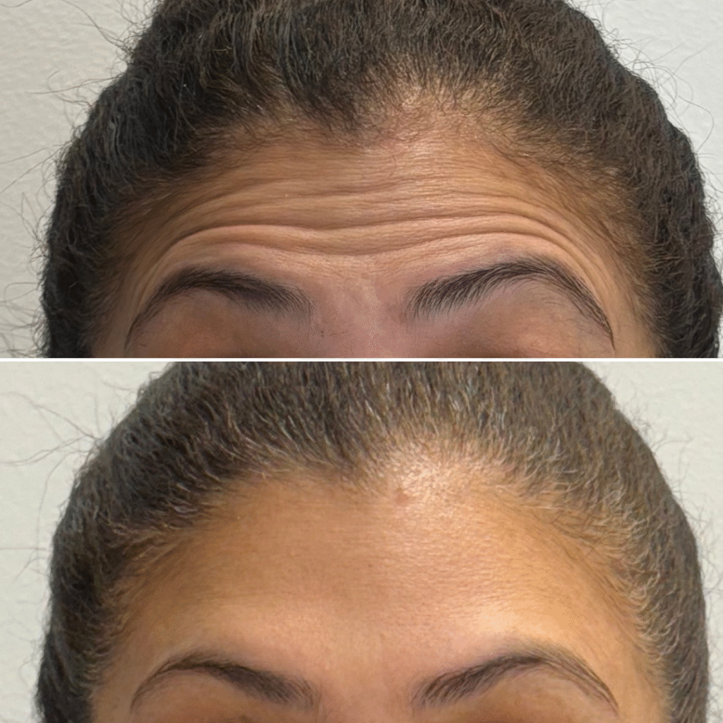 Botox