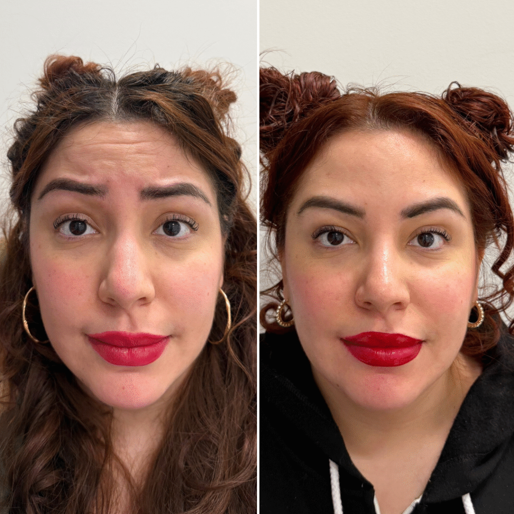 Botox
