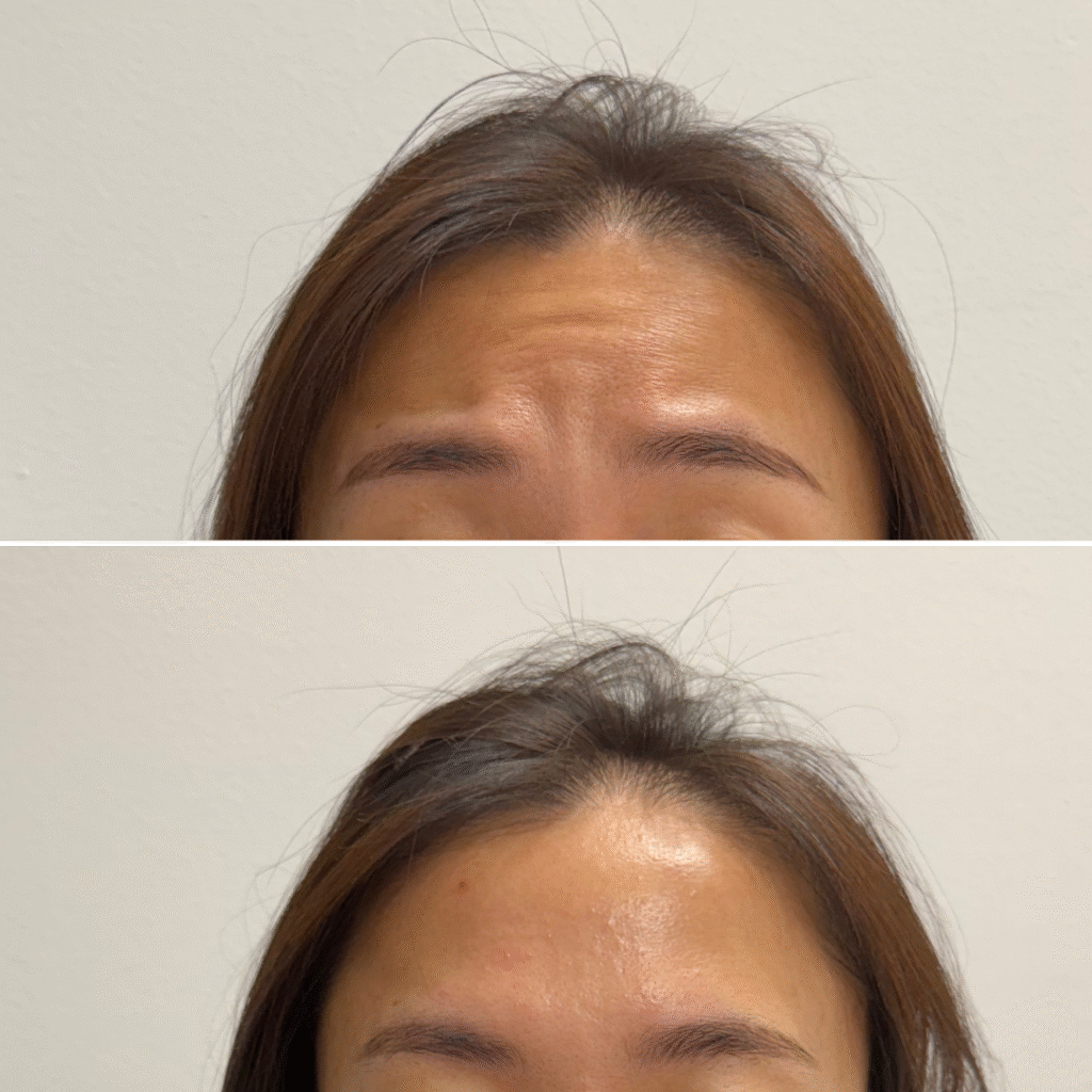 Botox