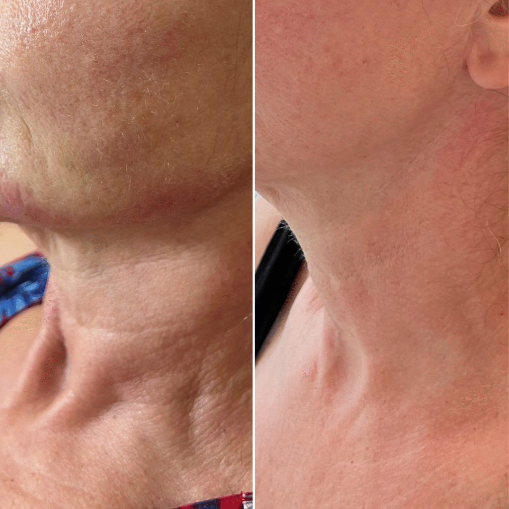 Neck Rejuvenation