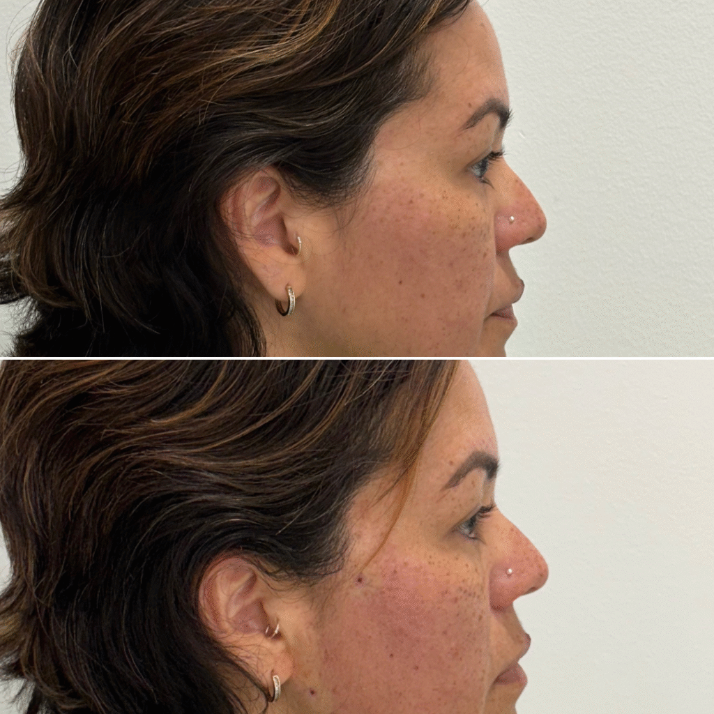 Non-surgical nose lift