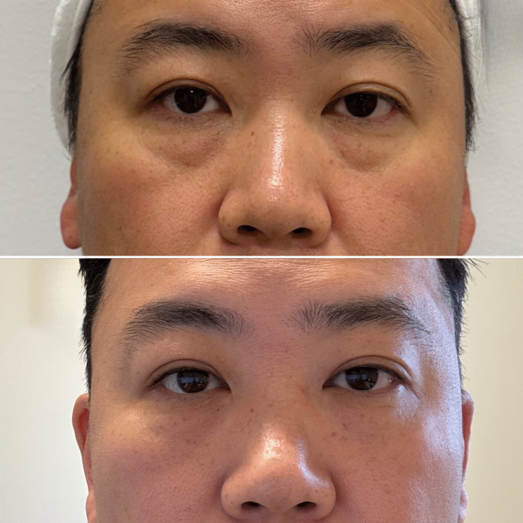 Under eye rejuvenation