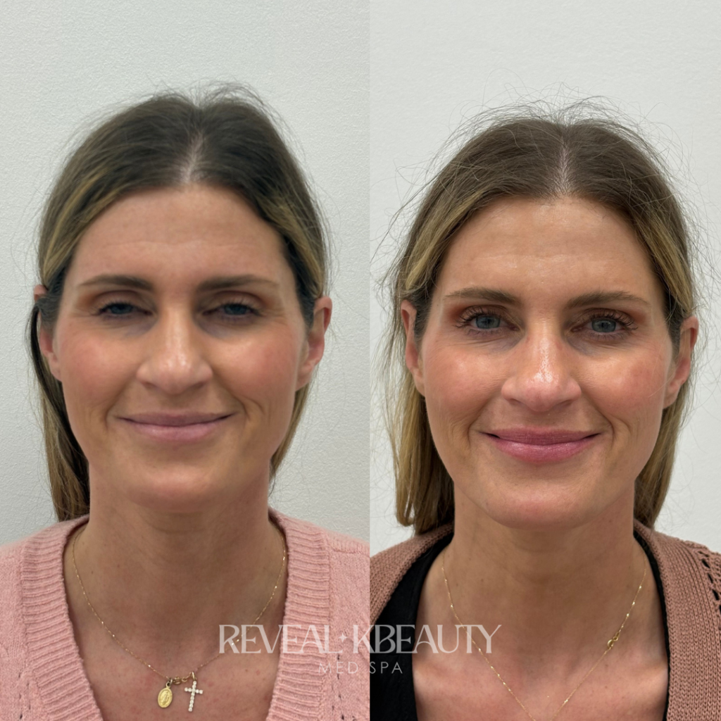 Facial Balancing with neurotoxi