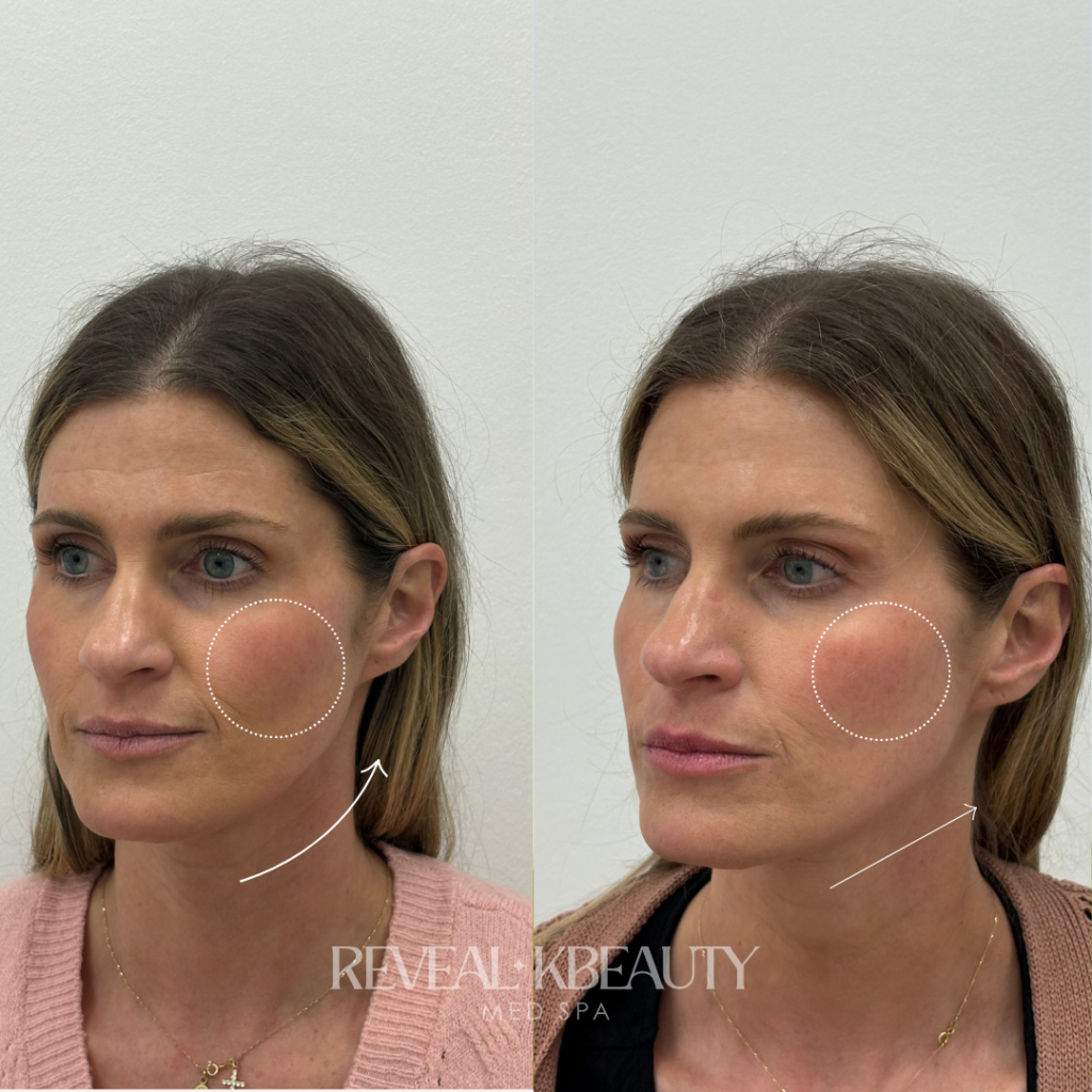 Facial Balancing with neurotoxin