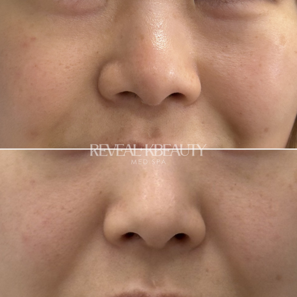 Nose Slimming with tox