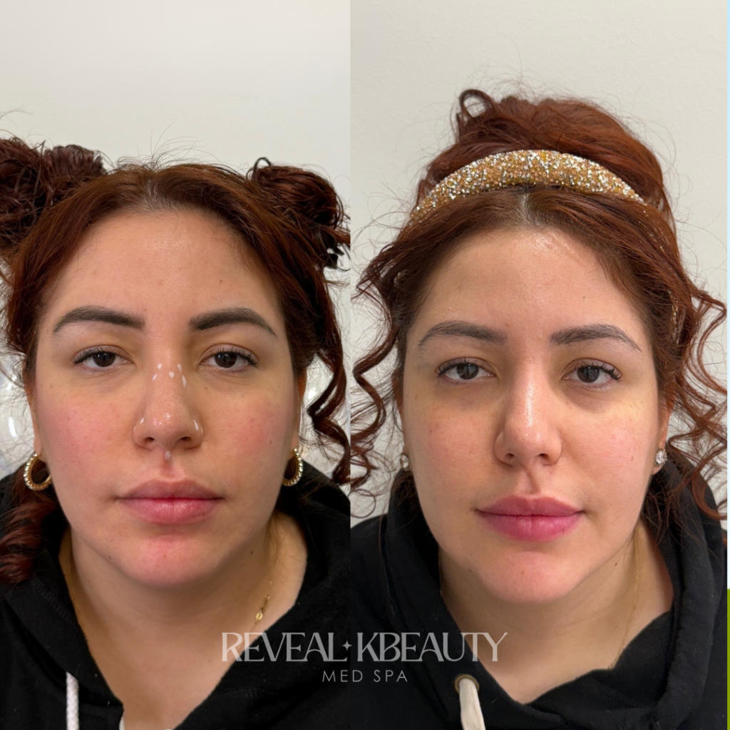 Non-surgical nose slimming