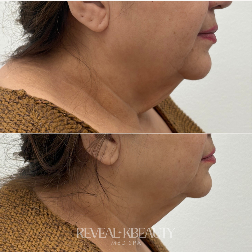 Reveal Neck Lift
