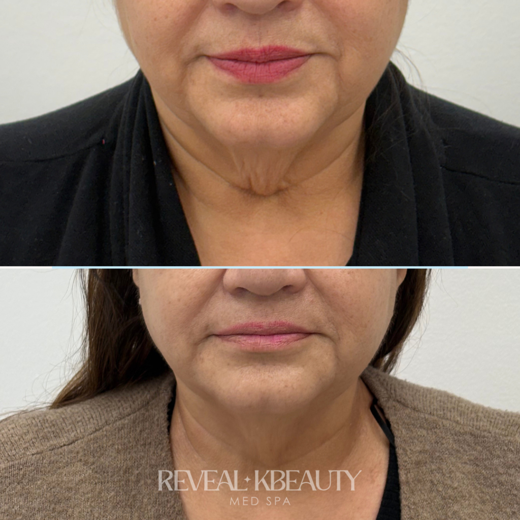 Reveal Neck Lift